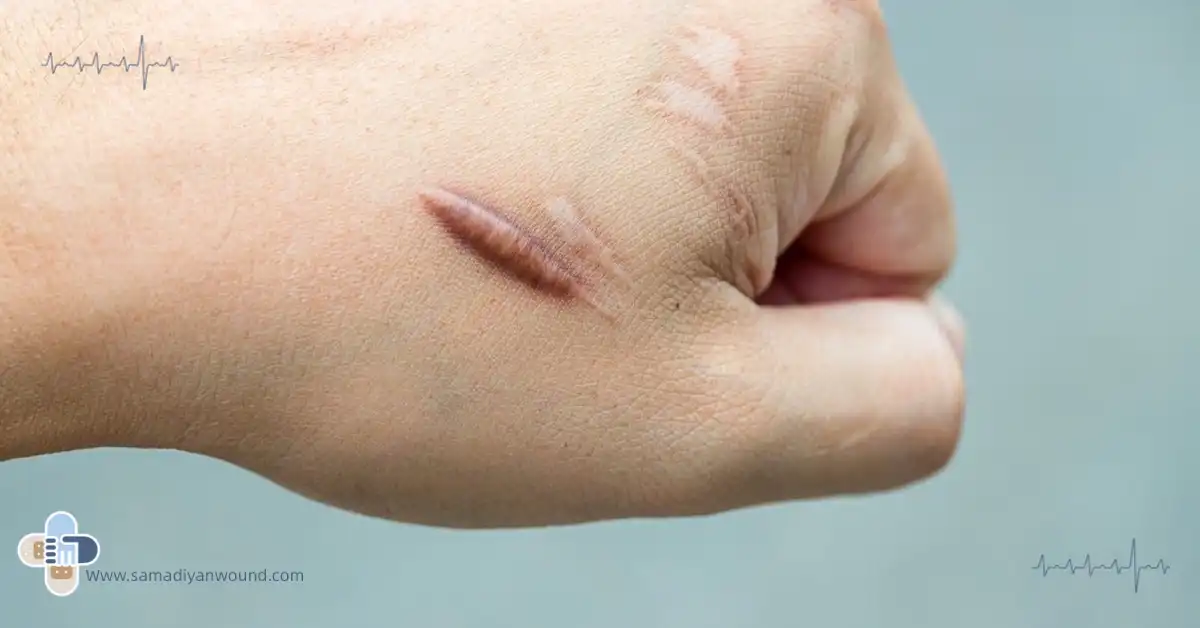 اسکار زخم سوختگی