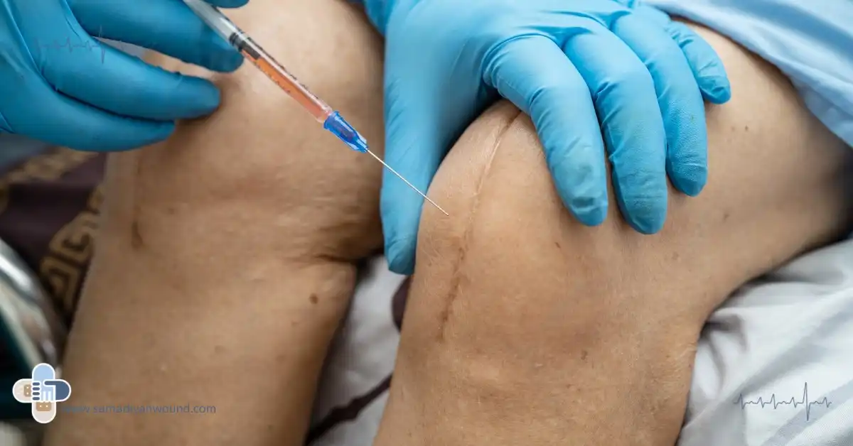 تزریق پی آر پی در زانو