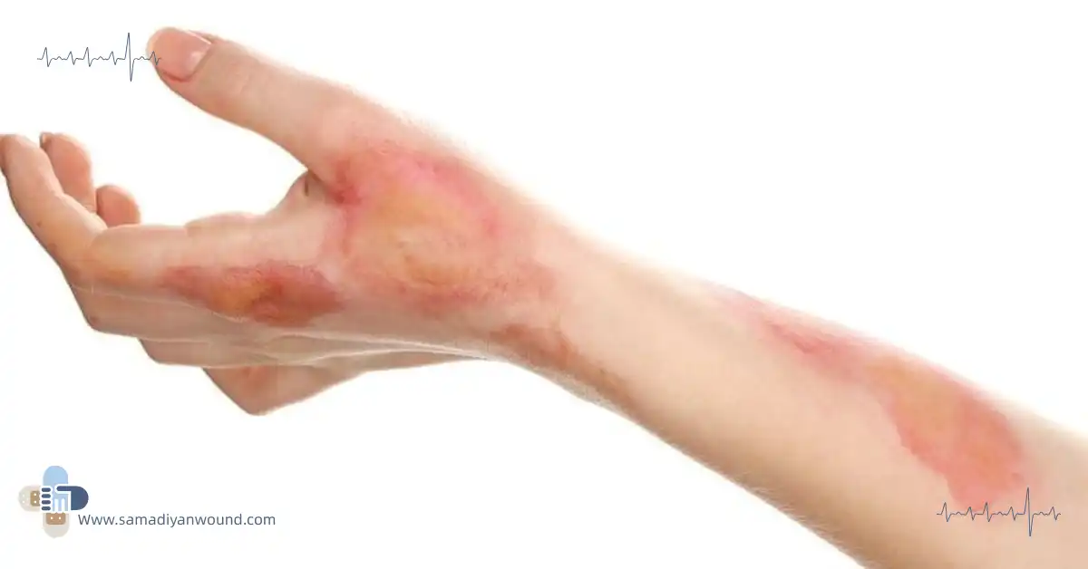 زخم سوختگی دست