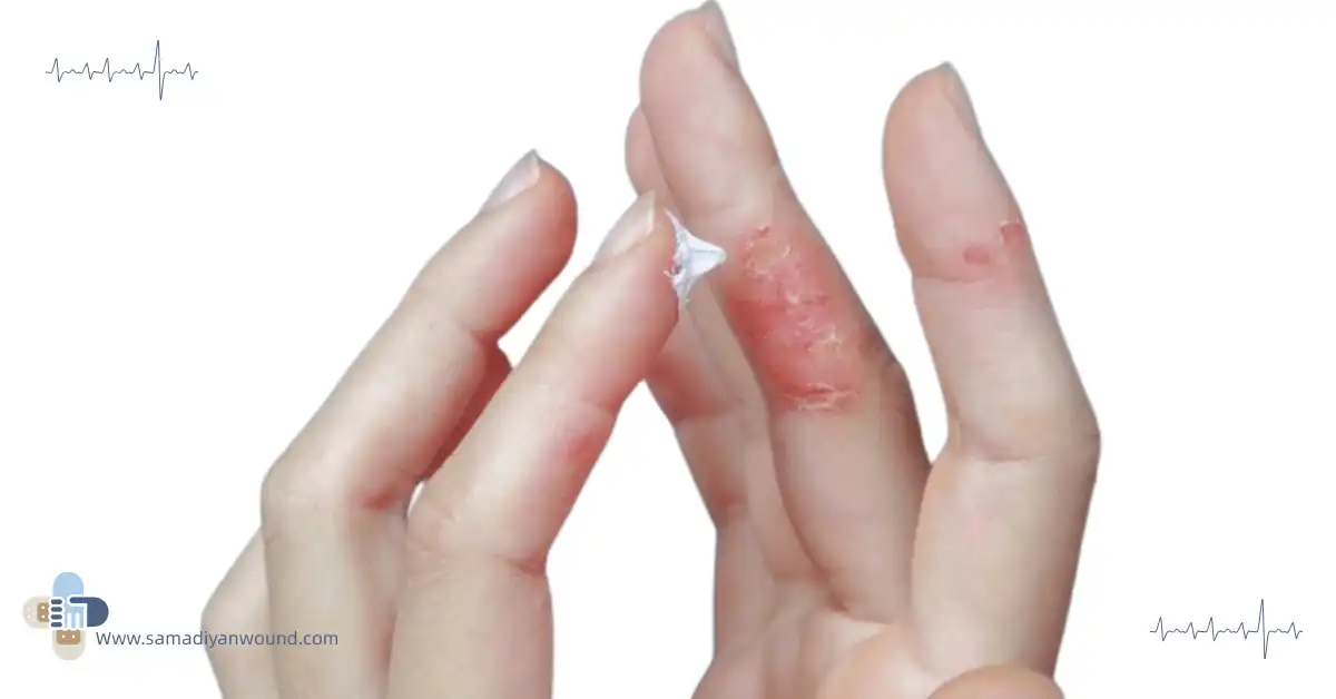 پماد برای درمان زخم عفونی