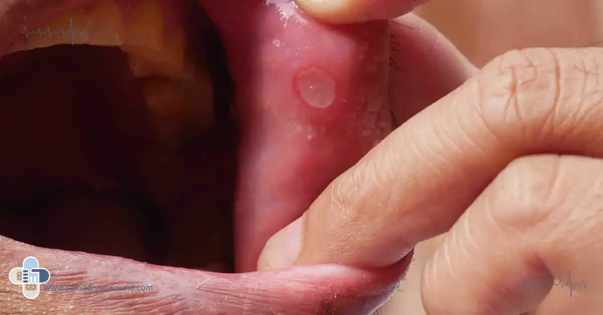 آفت دهان و زبان