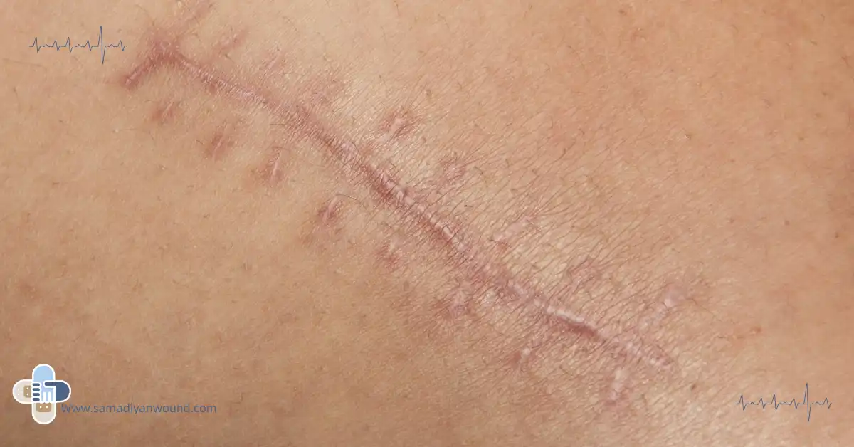 اسکار زخم