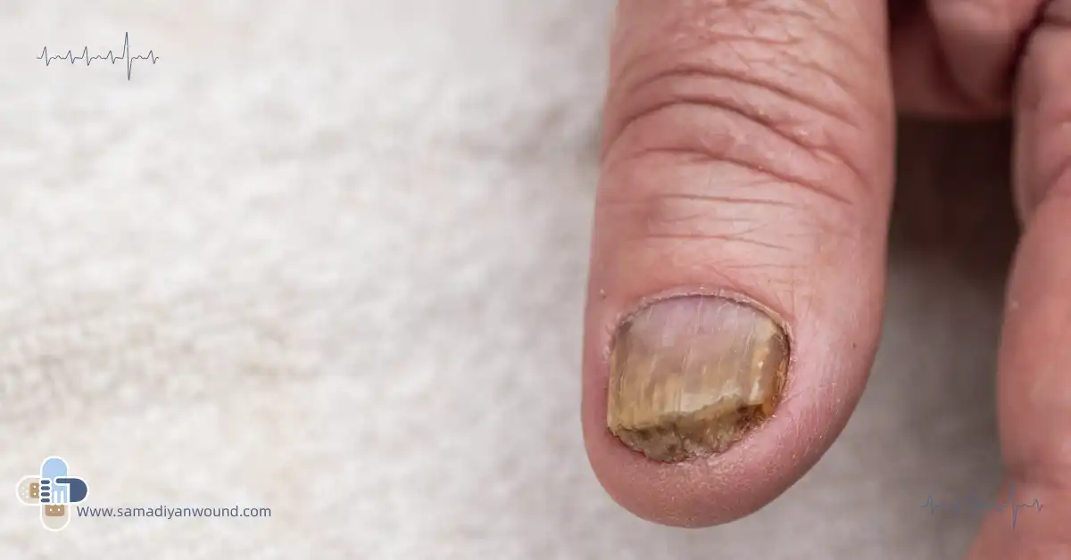 بیماری ناخن