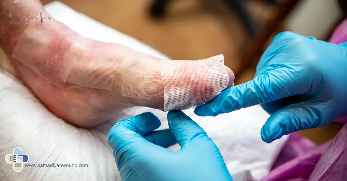 بیماری پروانه ای