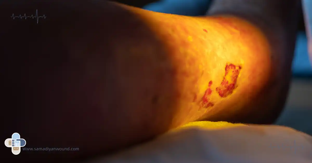 زخم پای وریدی