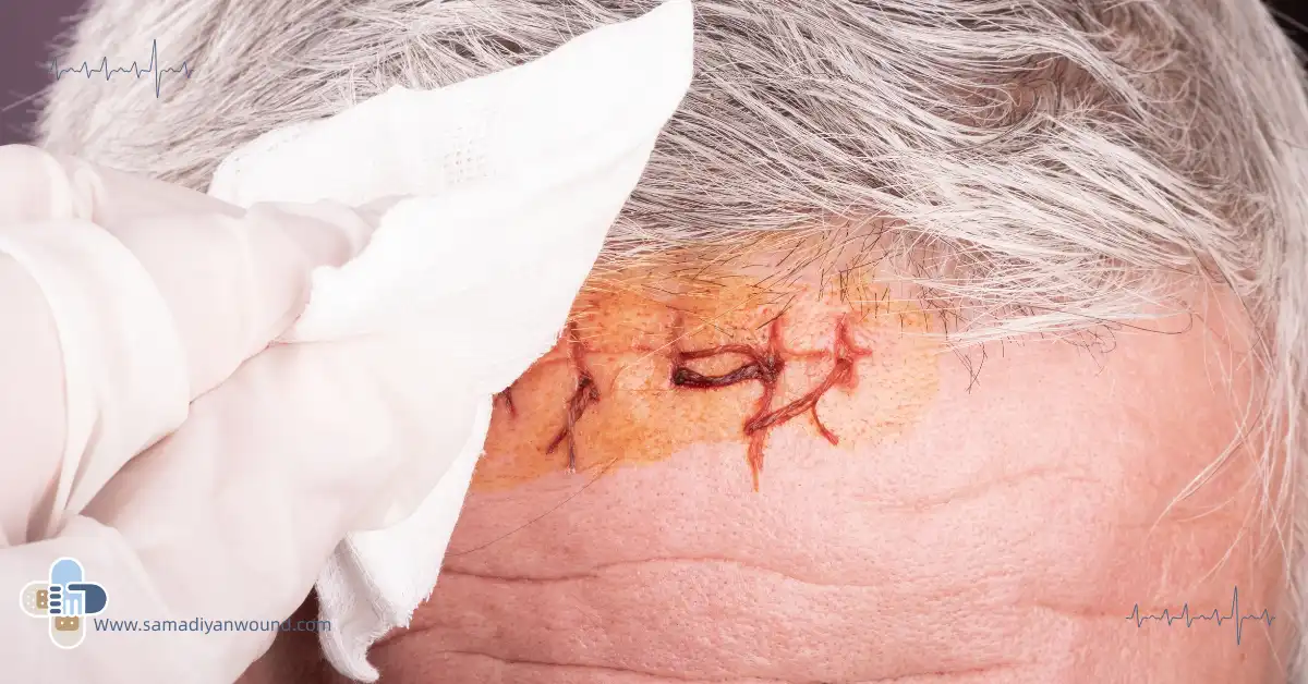 عفونت زخم جراحی سر