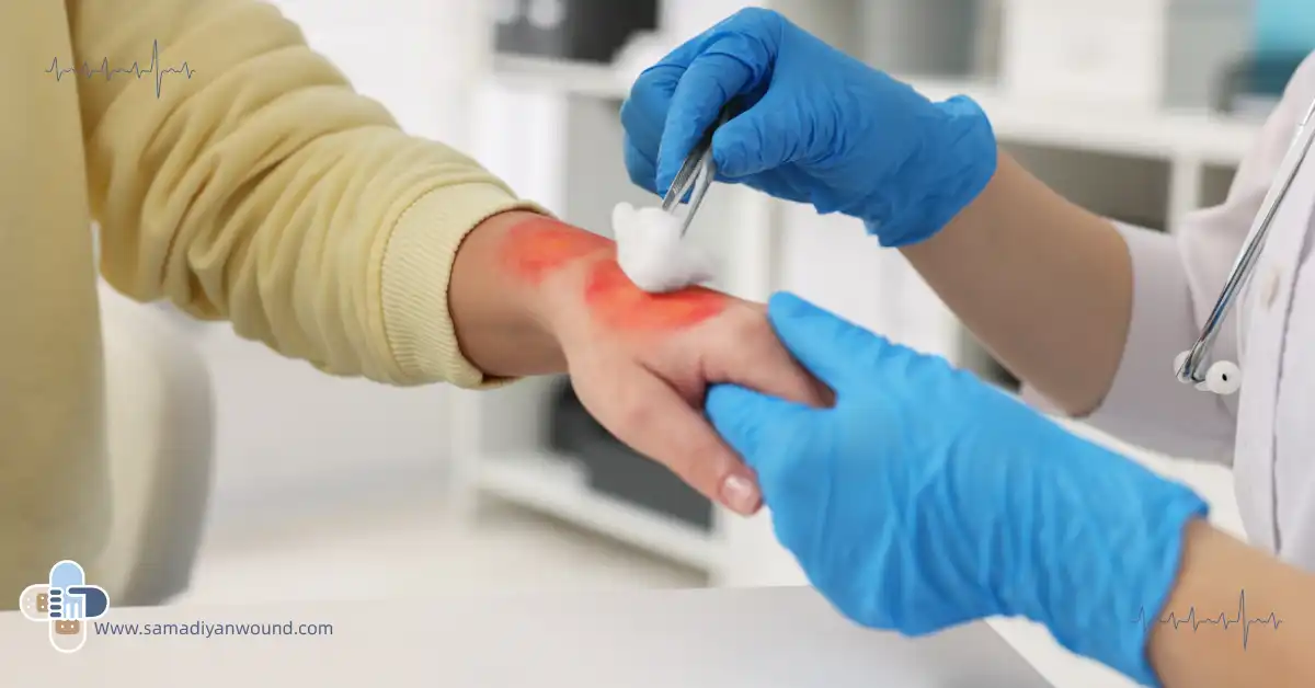 درمان سوختگی