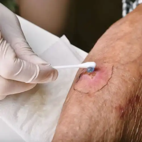 مراجعه به پزشک برای ارزیابی زخم