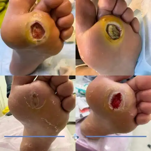 درمان زخم پای دیابتی پیشرفته در کلینیک زخم صمدیان