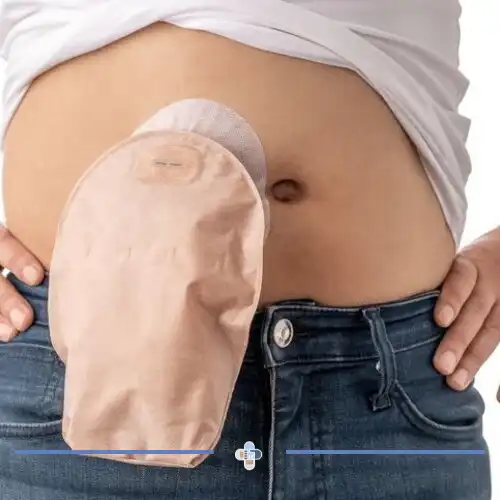 درمان زخم های استوما