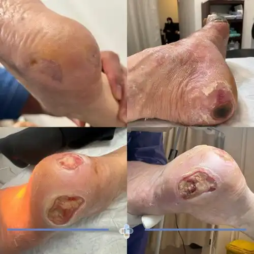 درمان زخم پای دیابتی پیشرفته