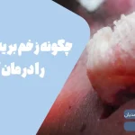 درمان زخم چاقو