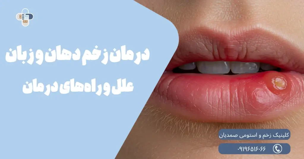 درمان زخم دهان و زبان
