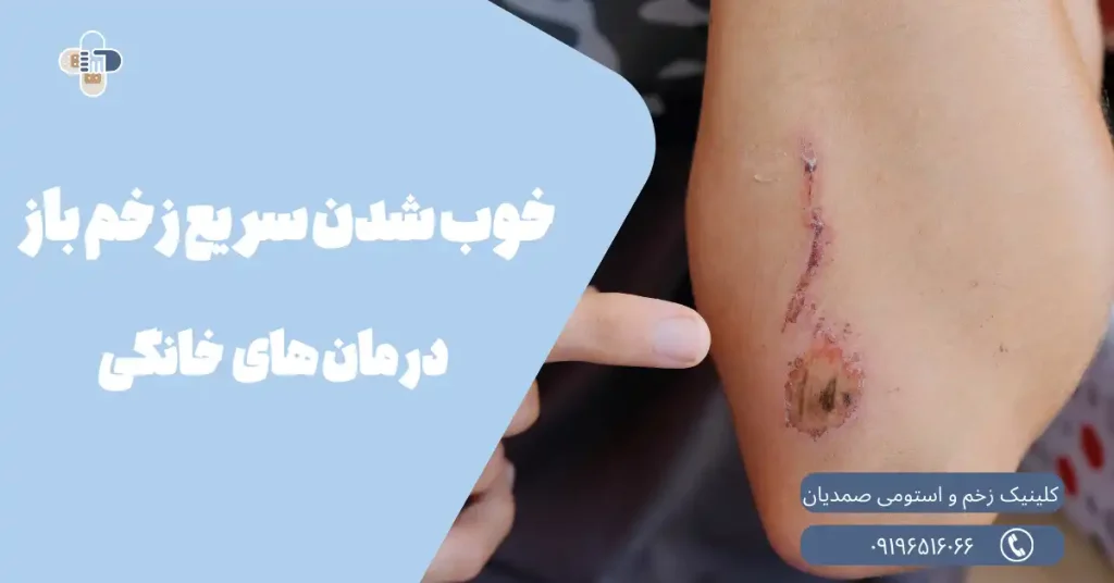 درمان زخم باز در خانه