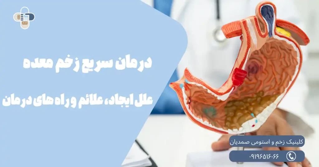 درمان سریع زخم معده