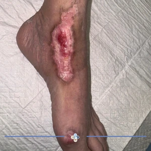 سوختگی با آتش